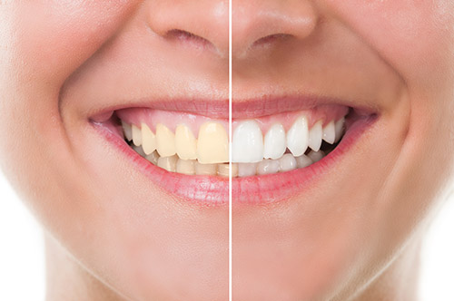 Professional Teeth Whitening Guthrie